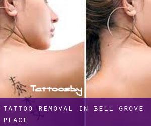 Tattoo Removal in Bell Grove Place