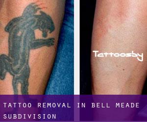Tattoo Removal in Bell Meade Subdivision