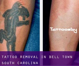 Tattoo Removal in Bell Town (South Carolina)