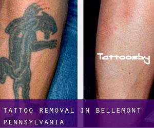 Tattoo Removal in Bellemont (Pennsylvania)