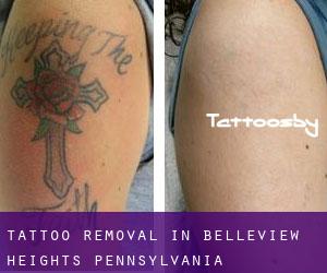 Tattoo Removal in Belleview Heights (Pennsylvania)