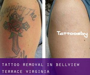 Tattoo Removal in Bellview Terrace (Virginia)