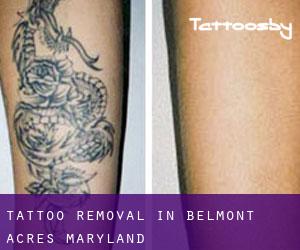 Tattoo Removal in Belmont Acres (Maryland)