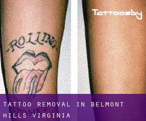 Tattoo Removal in Belmont Hills (Virginia)