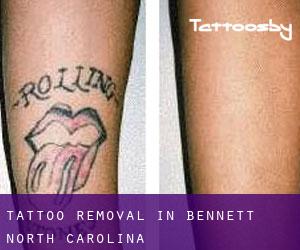 Tattoo Removal in Bennett (North Carolina)