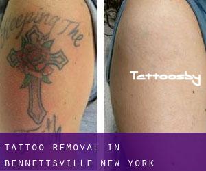 Tattoo Removal in Bennettsville (New York)