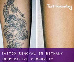 Tattoo Removal in Bethany Cooperative Community