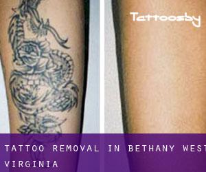 Tattoo Removal in Bethany (West Virginia)