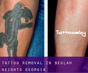 Tattoo Removal in Beulah Heights (Georgia)