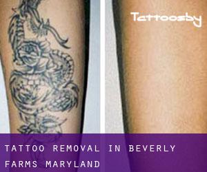 Tattoo Removal in Beverly Farms (Maryland)