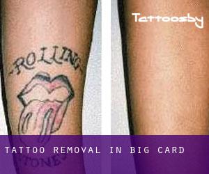 Tattoo Removal in Big Card