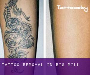 Tattoo Removal in Big Mill