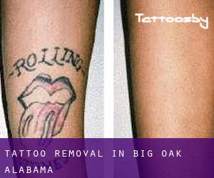 Tattoo Removal in Big Oak (Alabama)
