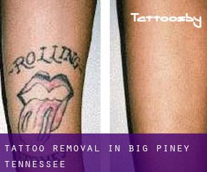 Tattoo Removal in Big Piney (Tennessee)