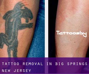 Tattoo Removal in Big Springs (New Jersey)