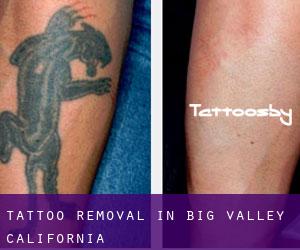 Tattoo Removal in Big Valley (California)