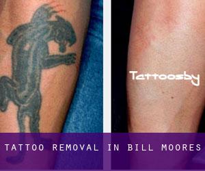 Tattoo Removal in Bill Moores