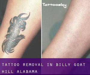 Tattoo Removal in Billy Goat Hill (Alabama)