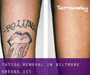 Tattoo Removal in Biltmore Greens III