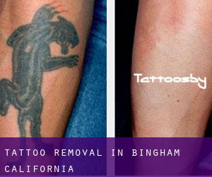 Tattoo Removal in Bingham (California)