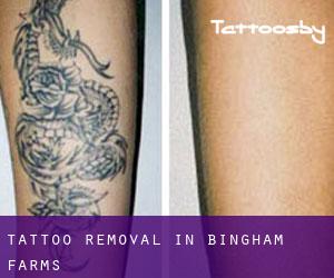 Tattoo Removal in Bingham Farms