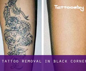 Tattoo Removal in Black Corner