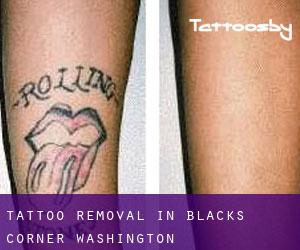 Tattoo Removal in Blacks Corner (Washington)