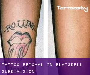Tattoo Removal in Blaisdell Subdivision