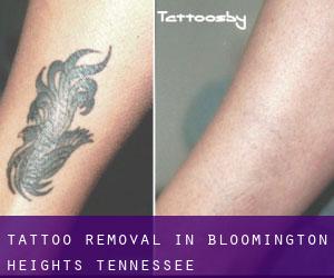 Tattoo Removal in Bloomington Heights (Tennessee)