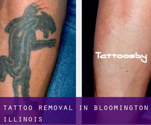 Tattoo Removal in Bloomington (Illinois)