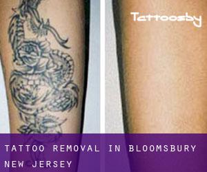 Tattoo Removal in Bloomsbury (New Jersey)
