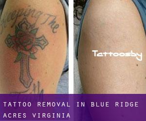 Tattoo Removal in Blue Ridge Acres (Virginia)