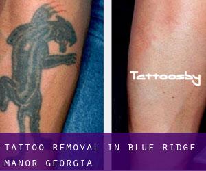 Tattoo Removal in Blue Ridge Manor (Georgia)