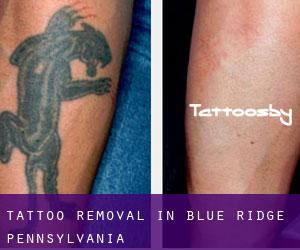 Tattoo Removal in Blue Ridge (Pennsylvania)