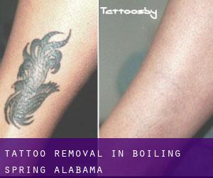 Tattoo Removal in Boiling Spring (Alabama)