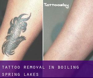 Tattoo Removal in Boiling Spring Lakes