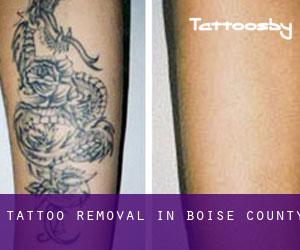 Tattoo Removal in Boise County