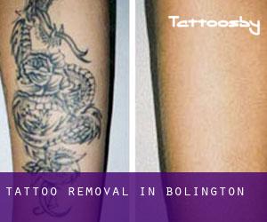 Tattoo Removal in Bolington