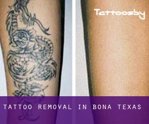 Tattoo Removal in Bona (Texas)