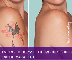 Tattoo Removal in Boones Creek (South Carolina)