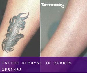 Tattoo Removal in Borden Springs