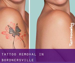 Tattoo Removal in Bordnersville