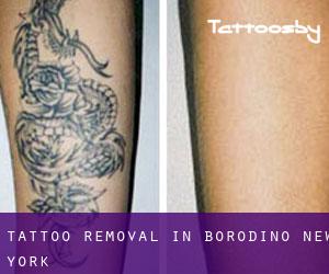 Tattoo Removal in Borodino (New York)