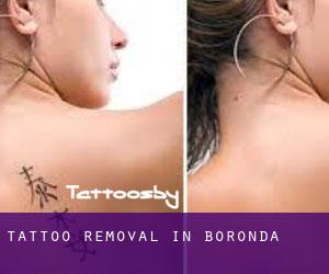 Tattoo Removal in Boronda