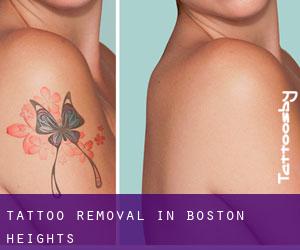 Tattoo Removal in Boston Heights