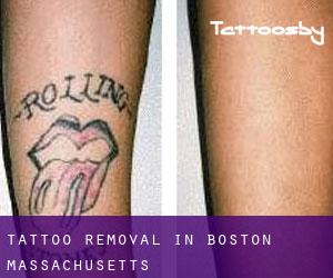Tattoo Removal in Boston (Massachusetts)
