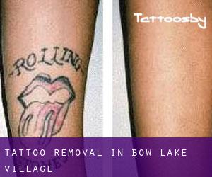 Tattoo Removal in Bow Lake Village