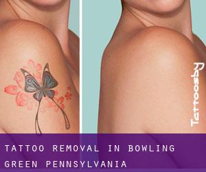 Tattoo Removal in Bowling Green (Pennsylvania)