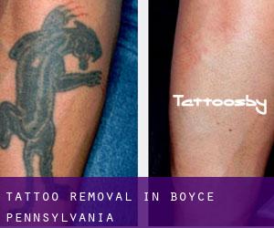 Tattoo Removal in Boyce (Pennsylvania)