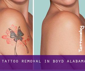 Tattoo Removal in Boyd (Alabama)
